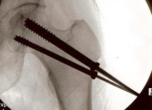 They look like chopsticks, but there are actually three pins